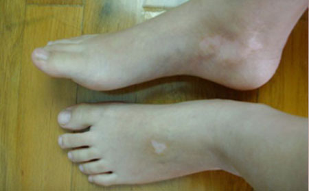 白癜風預防,預防白癜風方法,濰坊白癜風醫院