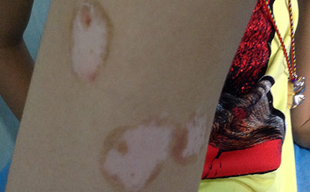 夏季白癜風,白癜風預防,濰坊白癜風醫院