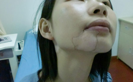 白癜風發病原因,白癜風癥狀,耳朵白癜風癥狀圖片