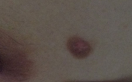 白癜風發病原因,引起白癜風的病因