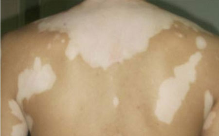 治療白癜風,白癜風激光治療,白癜風UVB,白癜風照光