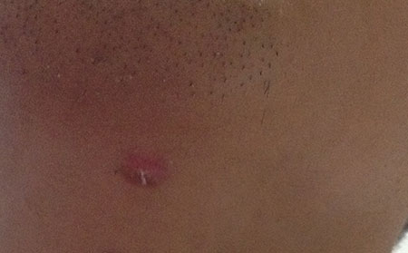 白癜風(fēng)發(fā)病原因,白癜風(fēng)的病因,引發(fā)白癜風(fēng)的病因有哪些