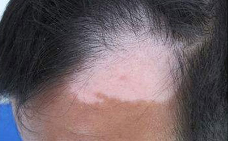 治療白癜風,藥物治療白癜風,濰坊治療白癜風醫院