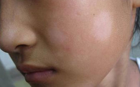 夏季白癜風,白癜風預(yù)防,預(yù)防白癜風措施