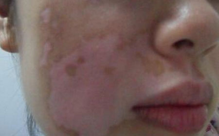 白癜風發病率,女性白癜風,男性白癜風
