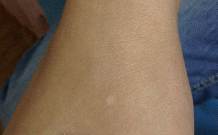 白癜風發病原因,誘發白癜風