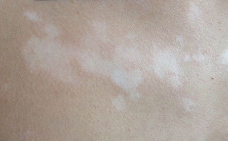 白癜風(fēng)發(fā)病原因,導(dǎo)致白癜的病因,微量元素缺乏