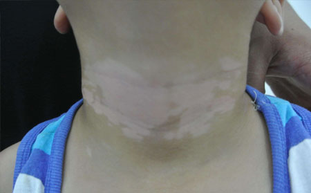 完全性白癜風造成的危害