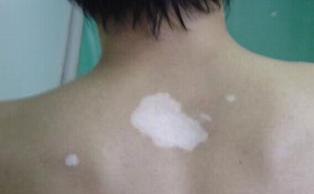 白癜風癥狀,頭部白癜風癥狀,白癜風癥狀有哪些表現