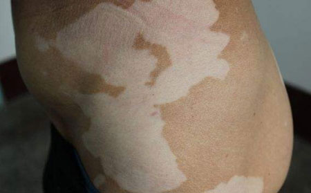 頭部白癜風,白癜風的危害有哪些