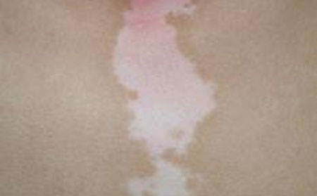 白癜風(fēng)癥狀,手部白癜風(fēng),白斑發(fā)病原因