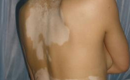 白癜風發病原因,手部白癜風癥狀