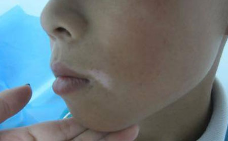 冬季白癜風(fēng),治療白癜風(fēng)比較好