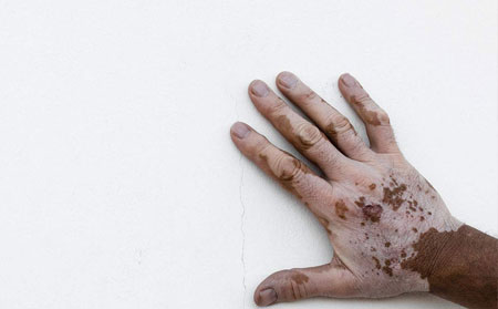 白癜風發病原因,引起白癜風的病因