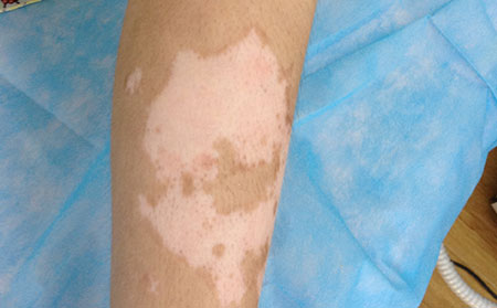 白癜風發病原因,白癜風的形成原因