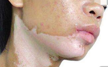 白癜風常識,白癜風要注意什么