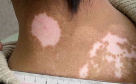 白癜風(fēng)發(fā)病原因,白癜風(fēng)是怎么形成的