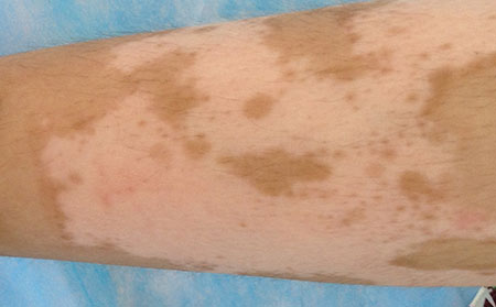 身上出現白點是白癜風嗎