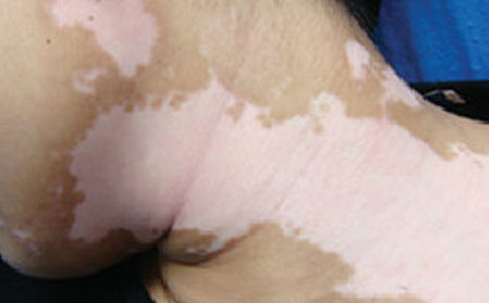 白癜風怎么治療,怎么治療散發(fā)型白癜風