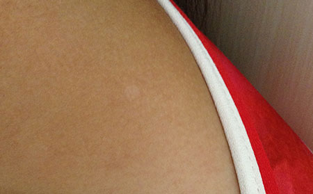 白癜風擴散的方法