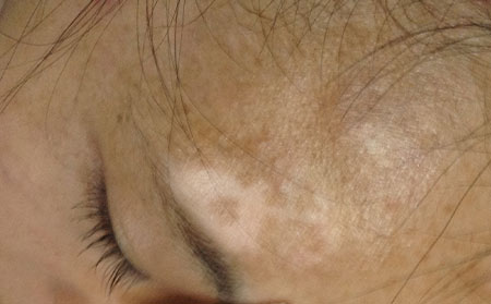 白癜風發病人群,嬰兒白癜風