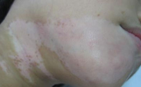 識別白癜風(fēng)的方法,判斷白癜風(fēng)方法,鑒別白癜風(fēng)方法