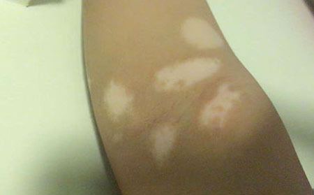 預防白癜風,預防局限型白癜風