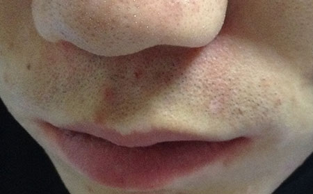 預防白癜風,預防泛發型白癜風