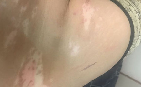 預防白癜風,如何有效預防白癜風