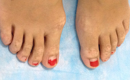 白癜風(fēng)白斑,白癜風(fēng)的檢查方法,如何確診白癜風(fēng)