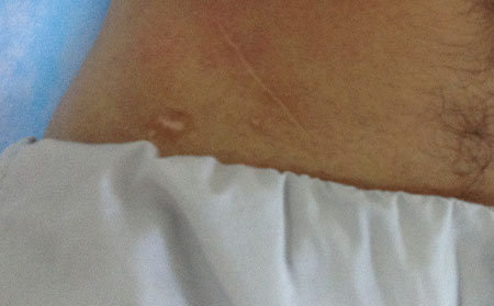 白癜風(fēng)的復(fù)發(fā),如何避免白癜風(fēng)的復(fù)發(fā)