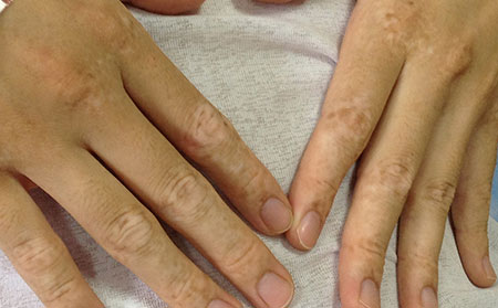 白癜風鑒別,白癜風診斷,白癜風區別