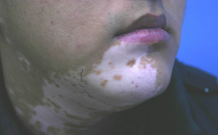 預防白癜風的方法