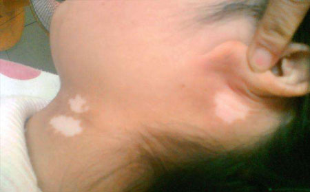 白癜風(fēng)護(hù)理方法,護(hù)理白癜風(fēng)方法