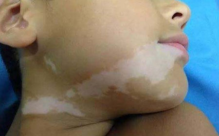 白癜風(fēng)護(hù)理,如何護(hù)理白癜風(fēng)