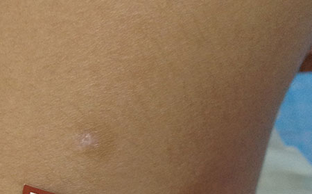 治療白癜風,輔助治療白癜風,白癜風預防護理