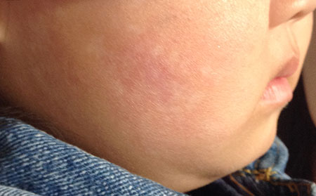 秋季白癜風患者需要注意什么呢