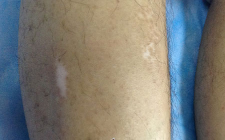 青少年身上出現(xiàn)白癜風(fēng)了怎么辦