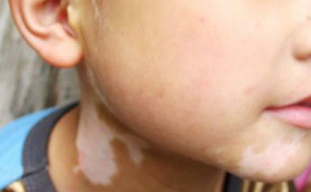 治療白癜風,白癜風怎么治,青少年白癜風怎么治