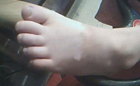 青少年得了白癜風都有哪些特點