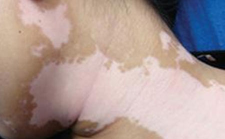 怎樣治療青少年白癜風