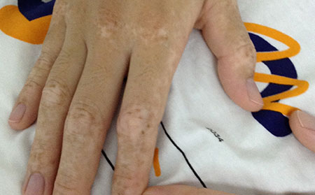 平時怎么護理白癜風疾病