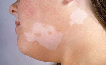 皮膚病患者更容易得白癜風嗎