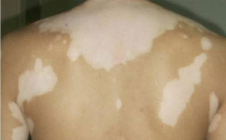皮膚上的白癜風是怎么形成的