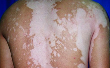 皮膚上起白斑是白癜風嗎