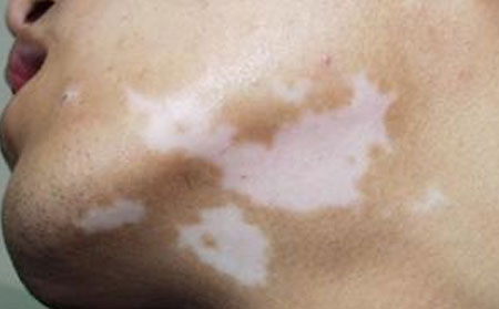 白癜風遺傳嗎,白癜風具有遺傳性嗎,怎樣預防白癜風的發生