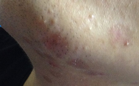 白癜風遺傳嗎,避免白癜風遺傳有哪些注意事項呢