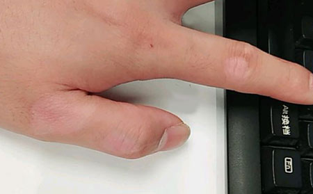 初期白癜風會不會遺傳?白癜風怎么護理好呢