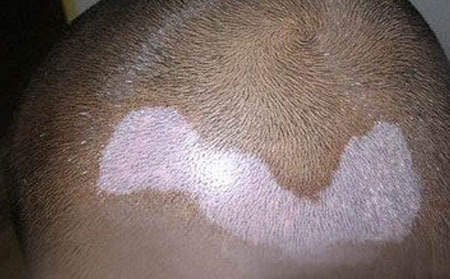 白癜風遺傳嗎,老婆有白癜風會不會以后遺傳給孩子