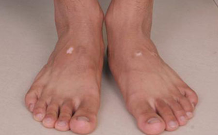 白癜風(fēng)傳染嗎,白癜風(fēng)疾病會傳染嗎